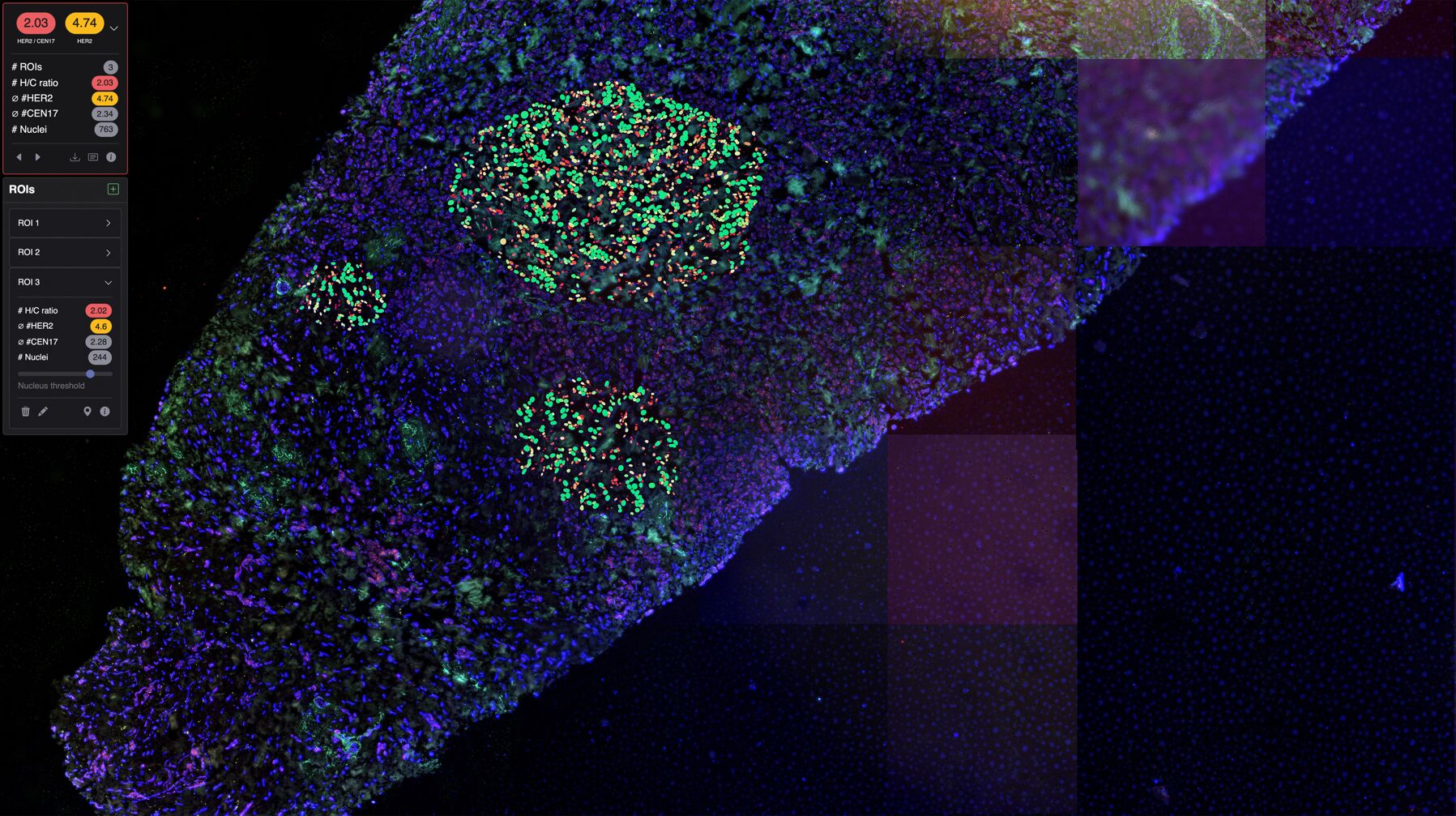 AI to fight cancer