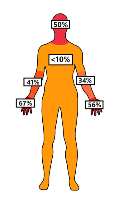 Bild 2 | Prozentuale Verteilung der thermischen Schädigung am Menschen